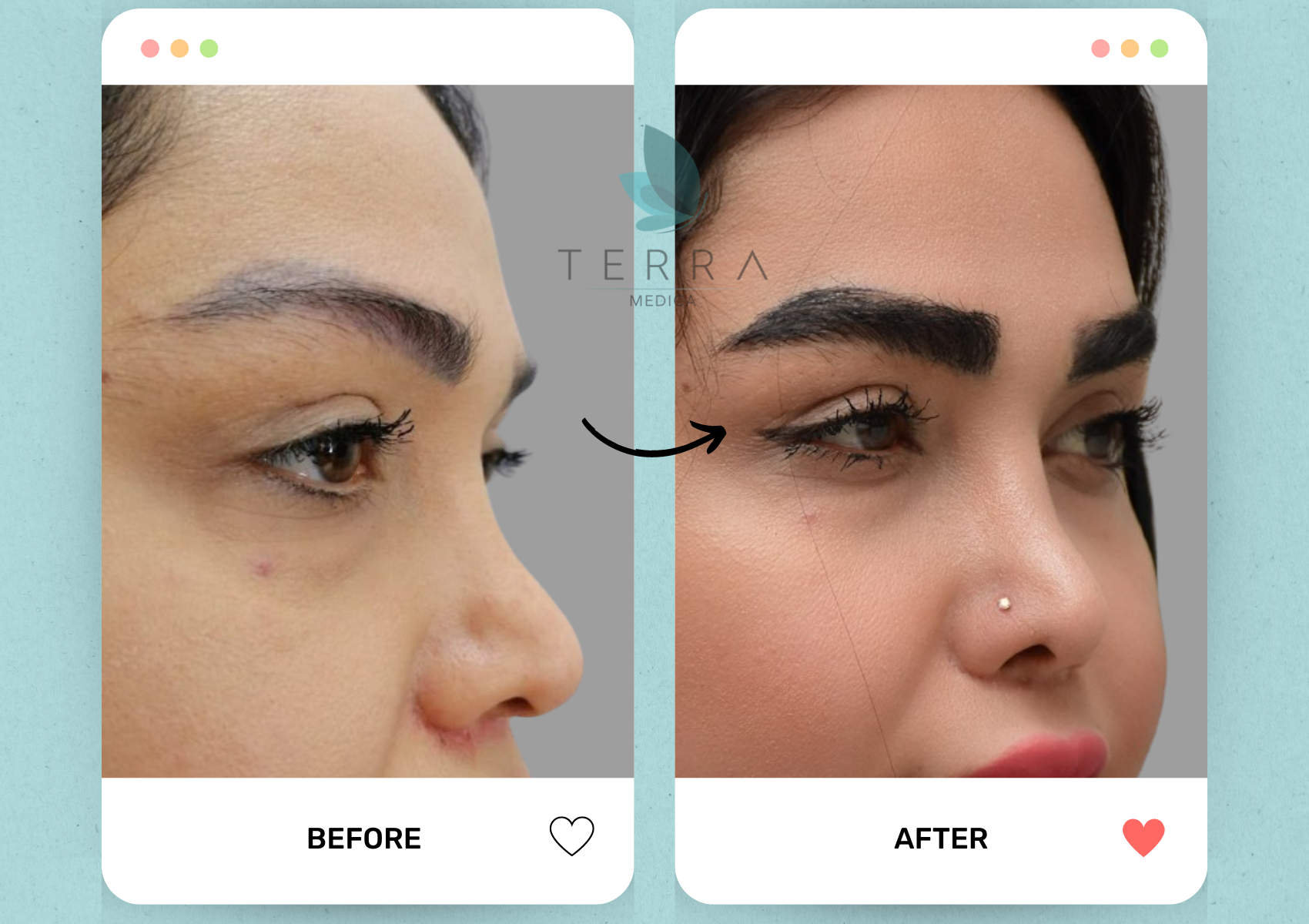 (Abnoos) Select Eyebrow Radiance Treatment + Accommodation