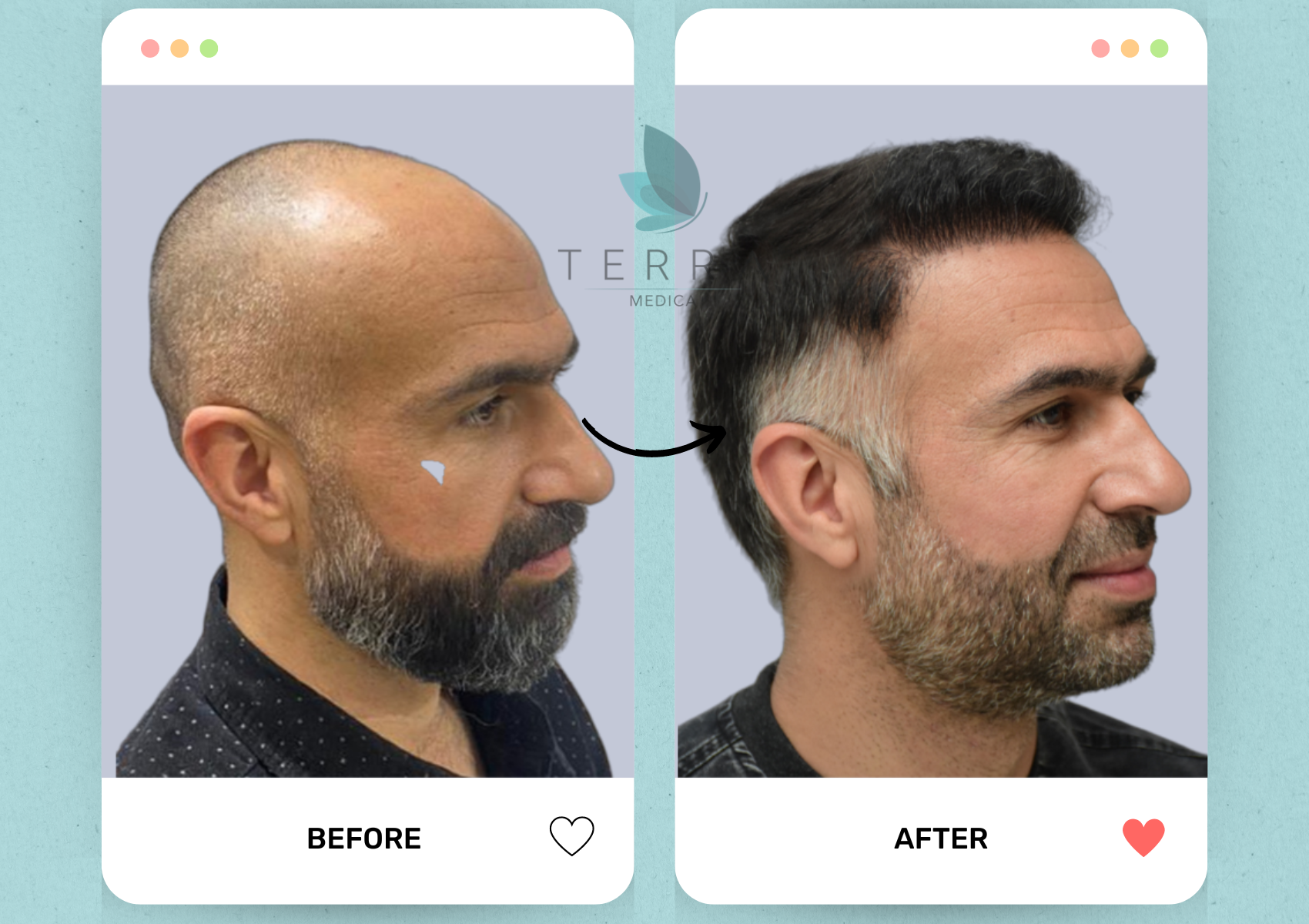 (Abnoos) Select Hair Restoration + Accommodation