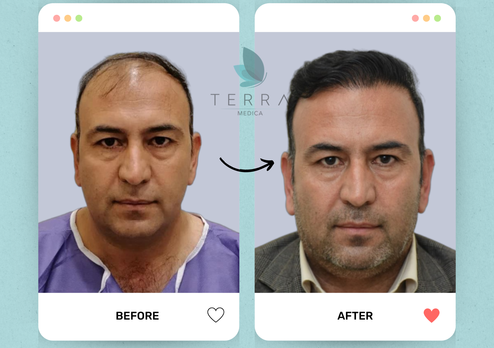 (Abnoos) Premium Hair Restoration + Accommodation