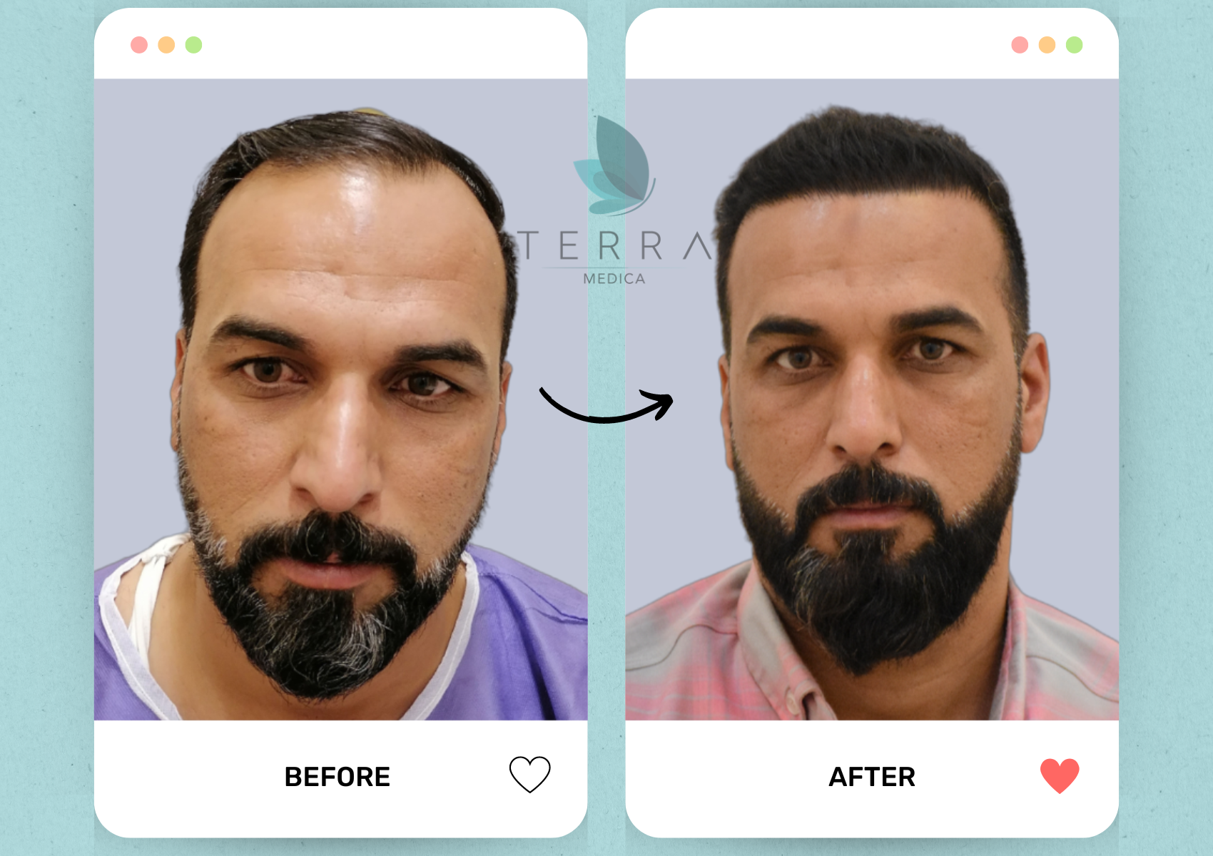 (Abnoos) Premium Hair Restoration + Accommodation