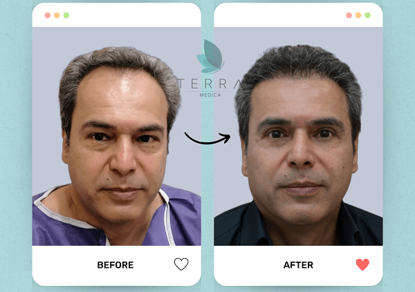 (Abnoos) Enhanced Hair Restoration + Accommodation