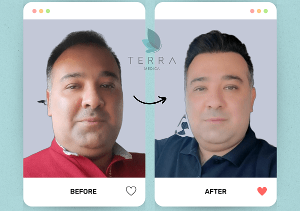 (Abnoos) Enhanced Hair Restoration + Accommodation