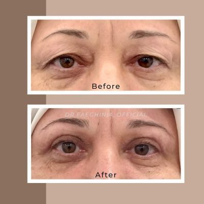 (Dr. Faeghinia) Timeless Eyes Blepharoplasty