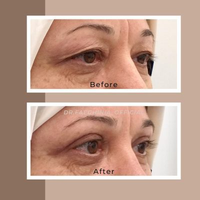 (Dr. Faeghinia) Timeless Eyes Blepharoplasty