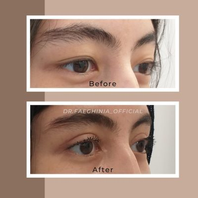 (Dr. Faeghinia) Timeless Eyes Blepharoplasty