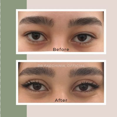 (Dr. Faeghinia) Timeless Eyes Blepharoplasty