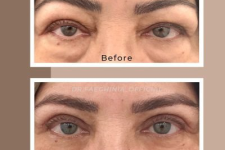 (Dr. Faeghinia) Timeless Eyes Blepharoplasty