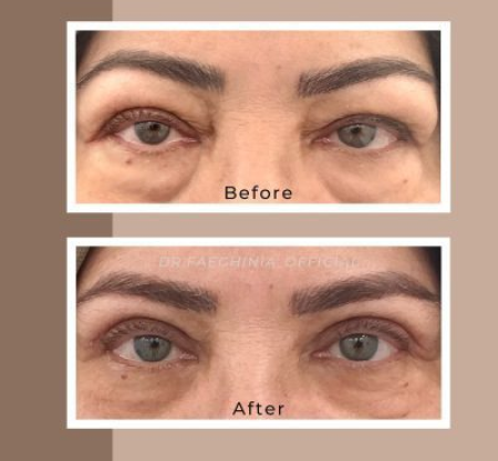 (Dr. Faeghinia) Timeless Eyes Blepharoplasty