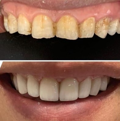 (Abtin) Composite Veneers Smile Renewal