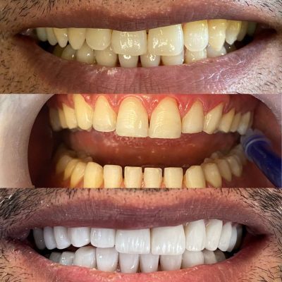 (Dr. Zanjankhah) Bright Smile Laminates