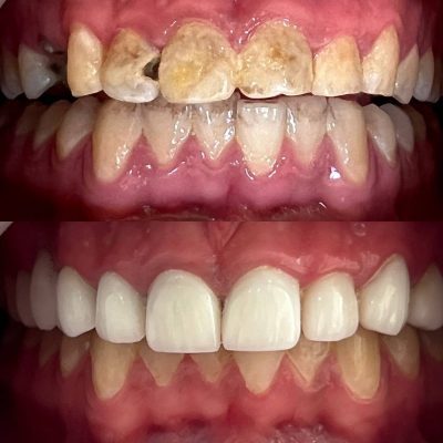 (Dr. Zanjankhah) Bright Smile Laminates