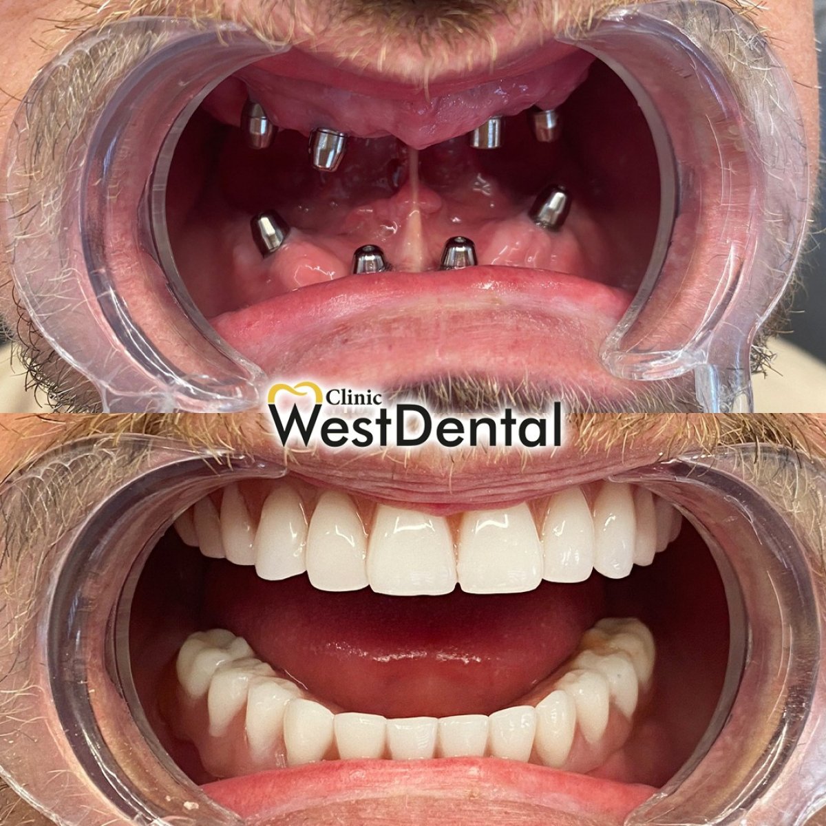 (WestDent) Full Smile Revitalization with All-on-4 Dental Implants