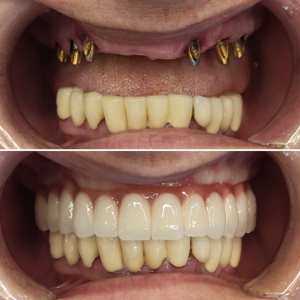 (WestDent) Full Smile Revitalization with All-on-6 Dental Implants