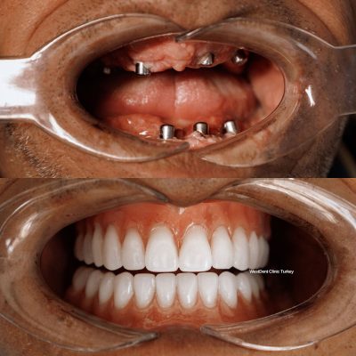 (WestDent) Full Smile Revitalization with All-on-4 Dental Implants