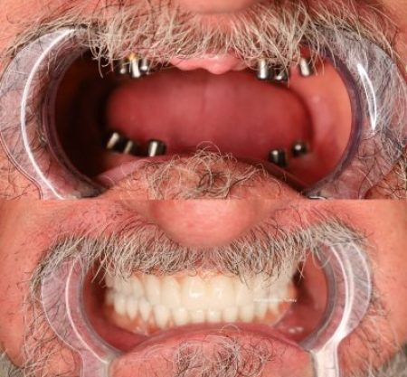 (WestDent) Full Smile Revitalization with All-on-6 Dental Implants