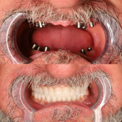 (WestDent) Full Smile Revitalization with All-on-6 Dental Implants