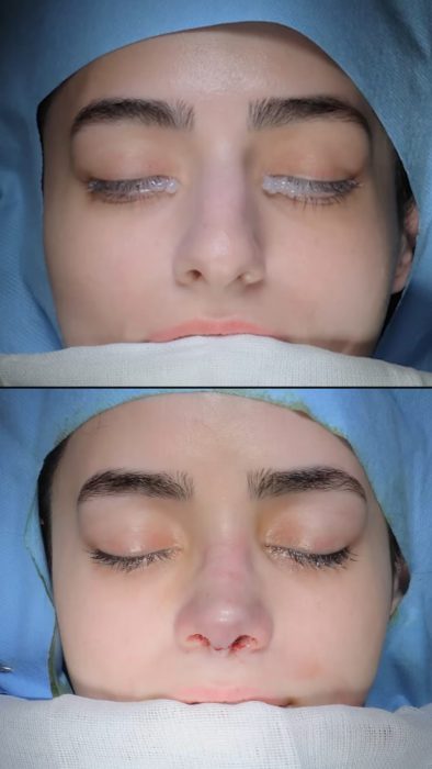 (Dr. Mohsen Fadaei) Perfect Profile Rhinoplasty