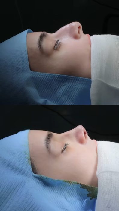 (Dr. Mohsen Fadaei) Perfect Profile Rhinoplasty