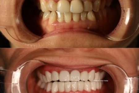 (WestDent) Veneer & Crown Total Smile Makeover