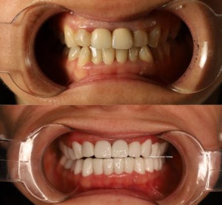 (WestDent) Veneer & Crown Total Smile Makeover