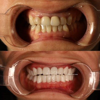 (WestDent) Veneer & Crown Total Smile Makeover