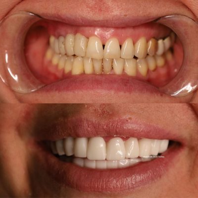 (WestDent) Veneer & Crown Total Smile Makeover