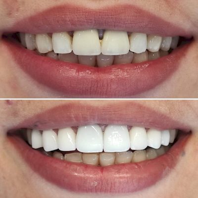 (WestDent) Veneer & Crown Total Smile Makeover