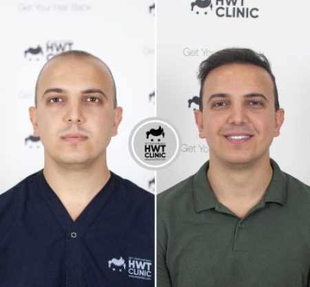 (HWT Clinic) FUE Hair Transplant Excellence Pack