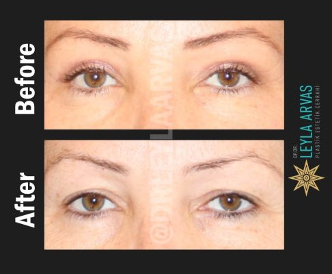 (Quartz Clinic) Upper Blepharoplasty Pack