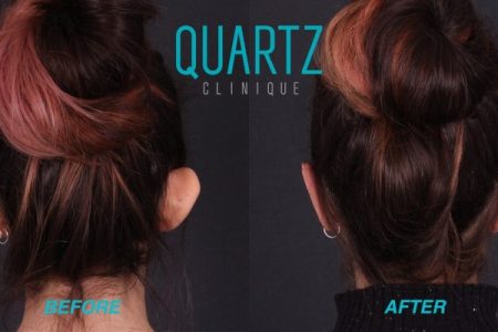 (Quartz Clinique) Otoplasty: Ear Reshaping Perfection Pack