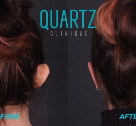 (Quartz Clinique) Otoplasty: Ear Reshaping Perfection Pack