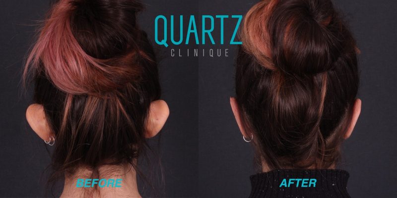 (Quartz Clinique) Otoplasty: Ear Reshaping Perfection Pack