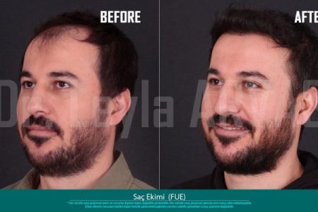 (Quartz Clinique)Precise Perfection: FUE Hair Transplant