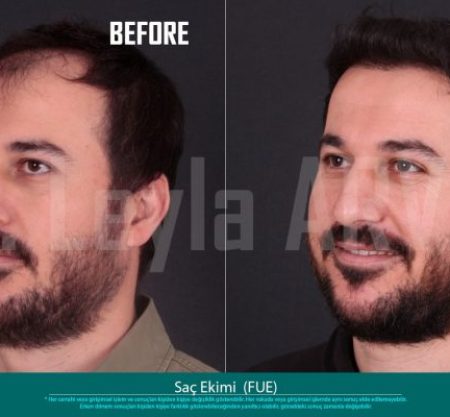 (Quartz Clinique)Precise Perfection: FUE Hair Transplant