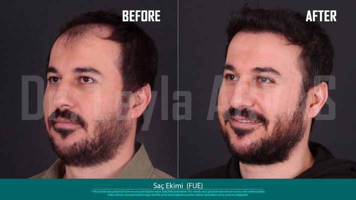 (Quartz Clinique)Precise Perfection: FUE Hair Transplant