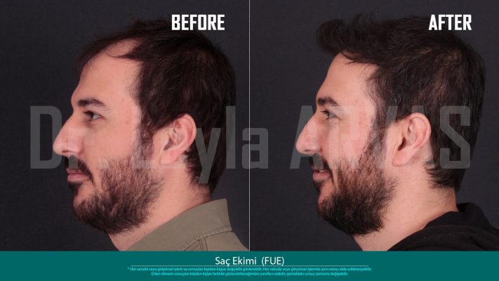 (Quartz Clinique)Precise Perfection: FUE Hair Transplant